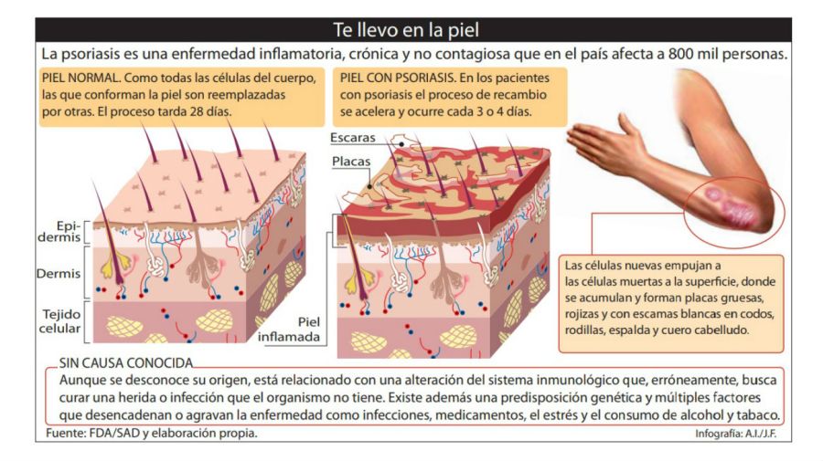 Infografía de la psoriasis.