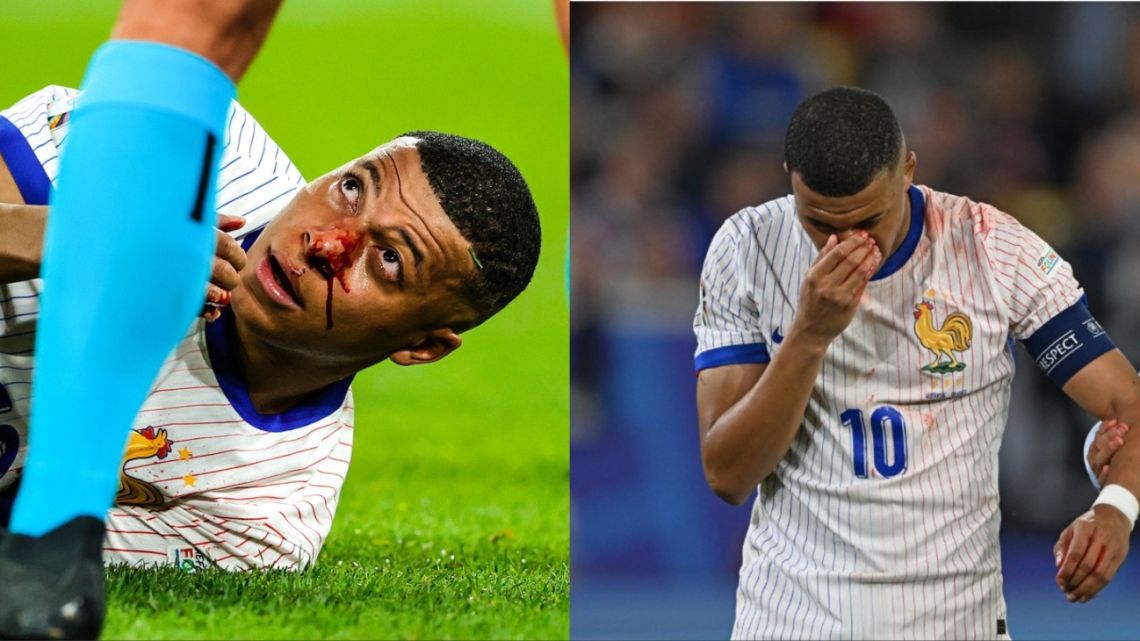 Mbappé se fracturó la nariz y podría perderse el resto de la Eurocopa 442