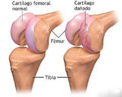 Diferencias entre una rodilla sana y una con lesiones condreales