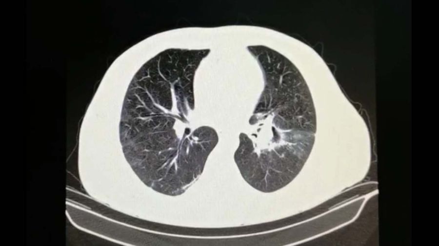 Mucormicosis pulmonar-20210527