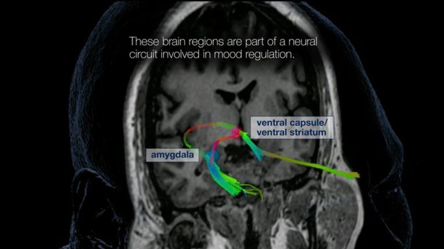 Dispositivo Cerebral Depresión