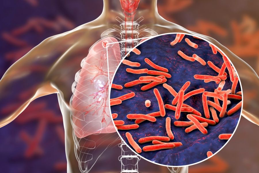 El regreso de la tuberculosis