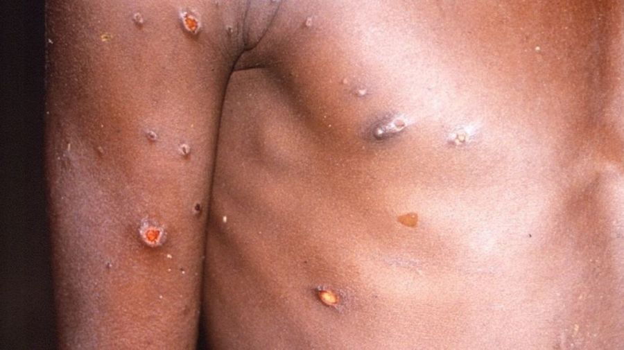 viruela monkeypox