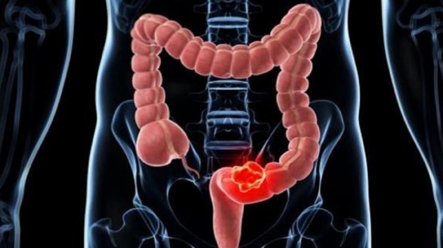 Nutrición: qué alimentos pueden aumentar el riesgo de padecer cáncer de colón