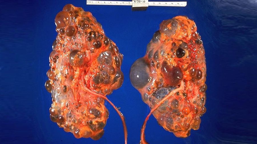 Poliquistosis renal