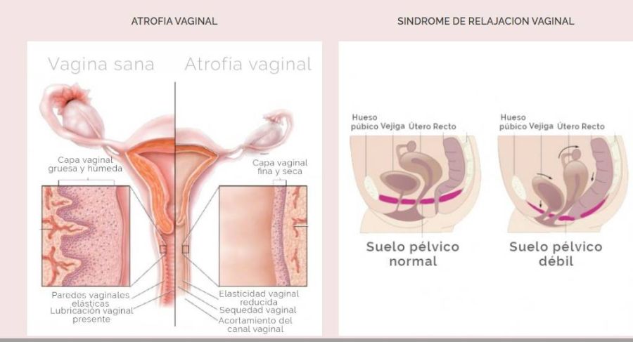Qué es la cirugía íntima femenina que se realizó Jesica Cirio