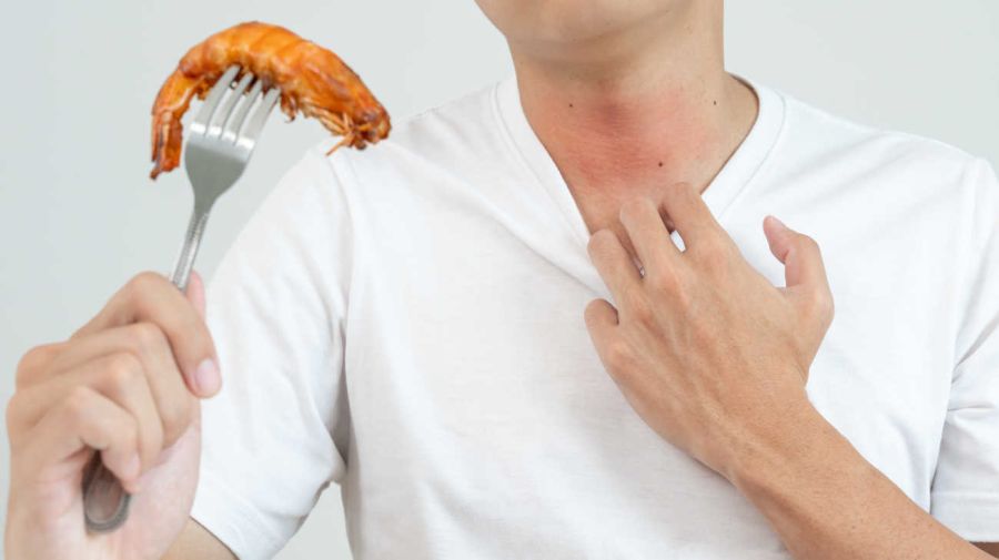 Alergias alimentarias 20240227