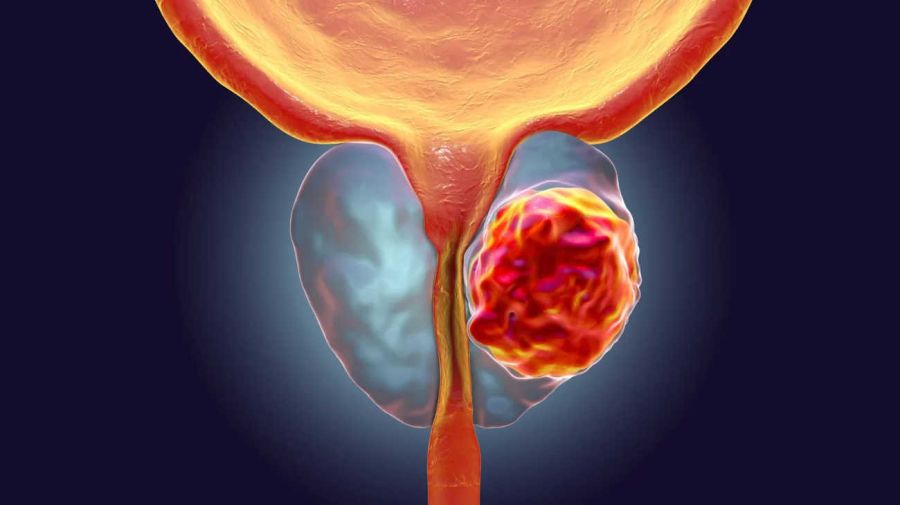 Cáncer de próstata 20240403