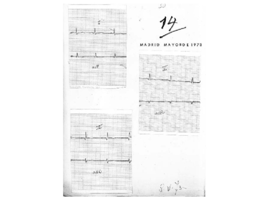 Electrocardiograma de Perón
