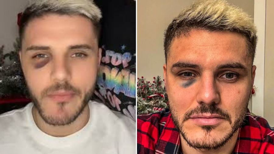 Mauro Icardi en 2023 rubio y con un moretón 