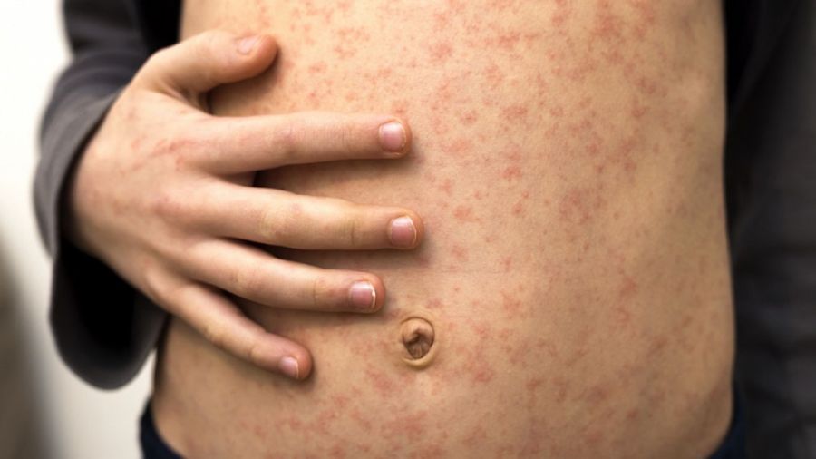 Crece la preocupación por la suba de casos de sarampión: además alertan por paperas y hepatitis A.