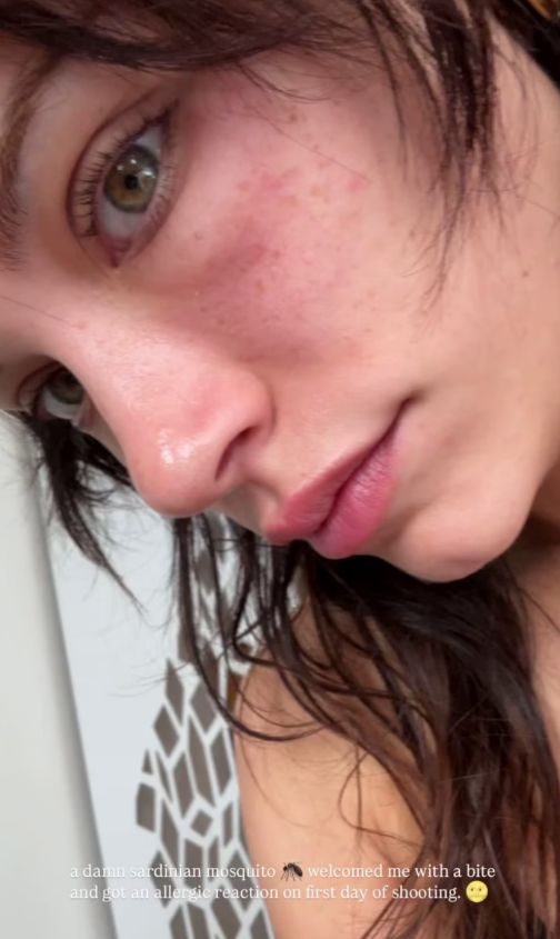 Eva de Dominicia mostró su alergia