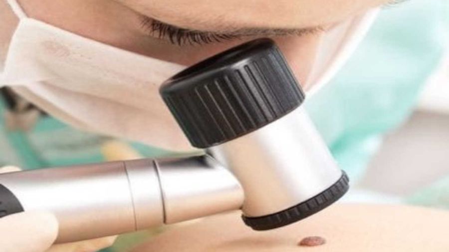 Cáncer de piel 20250520