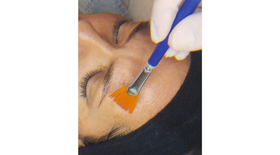 Peeling en invierno: tratamiento aliado para una piel renovada y luminosa