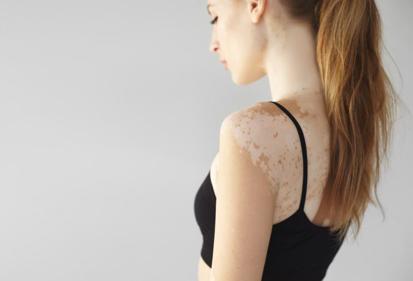 vitiligo
