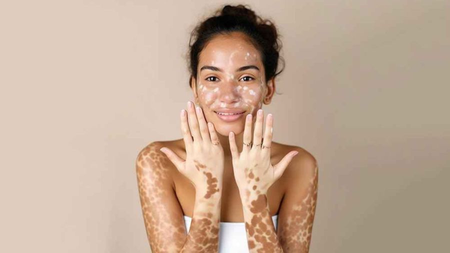 Vitiligo