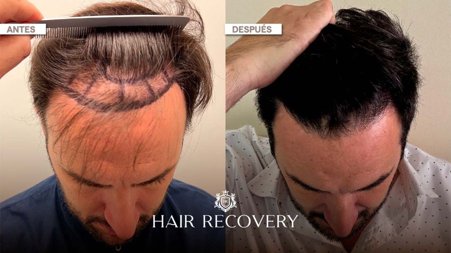Hair Recovery 14072025