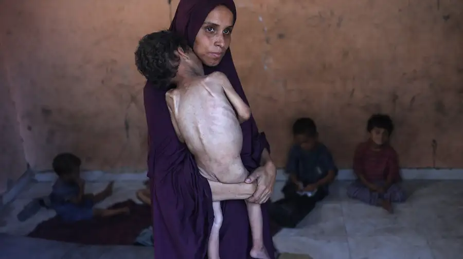 Desnutrición en Gaza 24072025