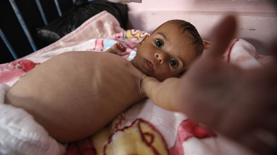 Desnutrición en Gaza 24072025