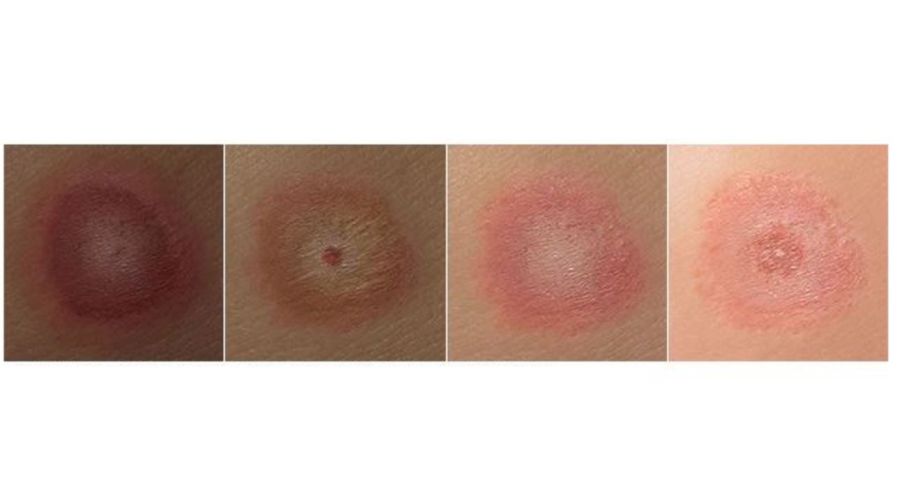 Sarpullido de la Enfermedad de Lyme