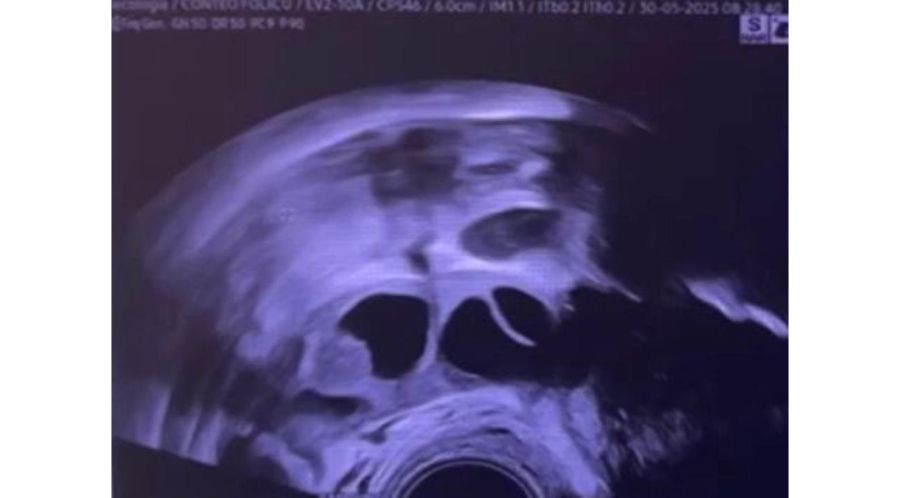 De la presión al control: cómo congelar óvulos te devuelve la tranquilidad