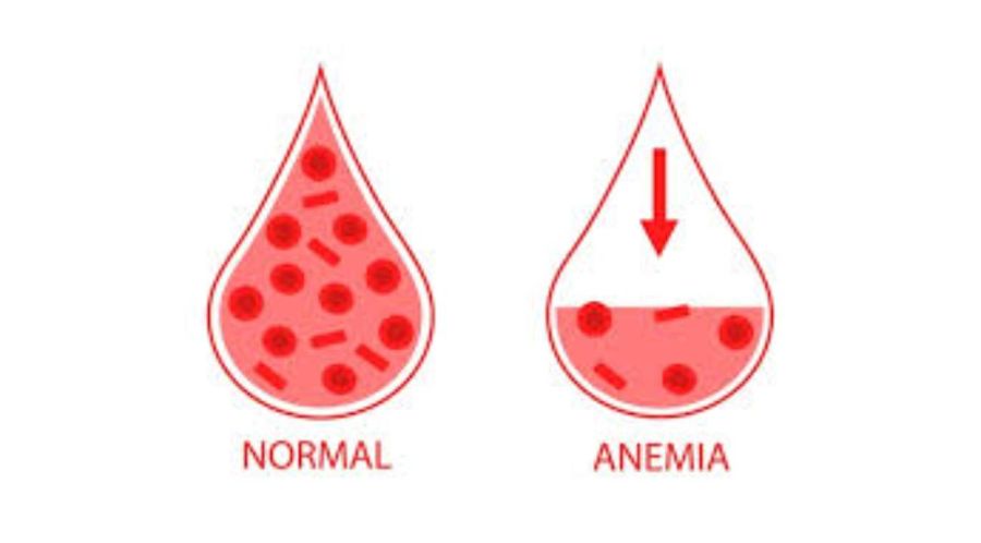 La anemia: una condición frecuente que aún pasa desapercibida