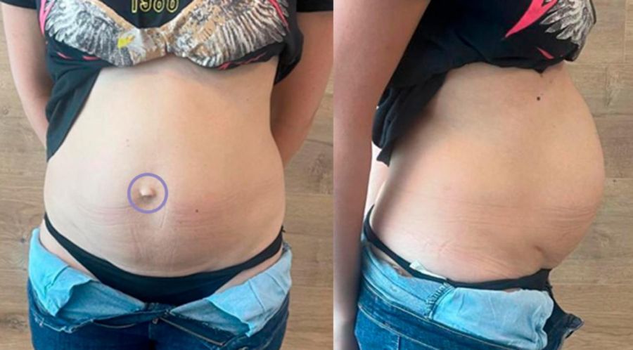 Hernia Umbilical y Diástasis: la asociación que afecta la salud y la estética femenina