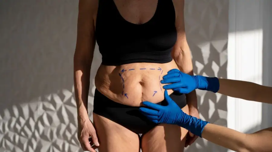 La cirugía bariátrica en clínicas argentinas