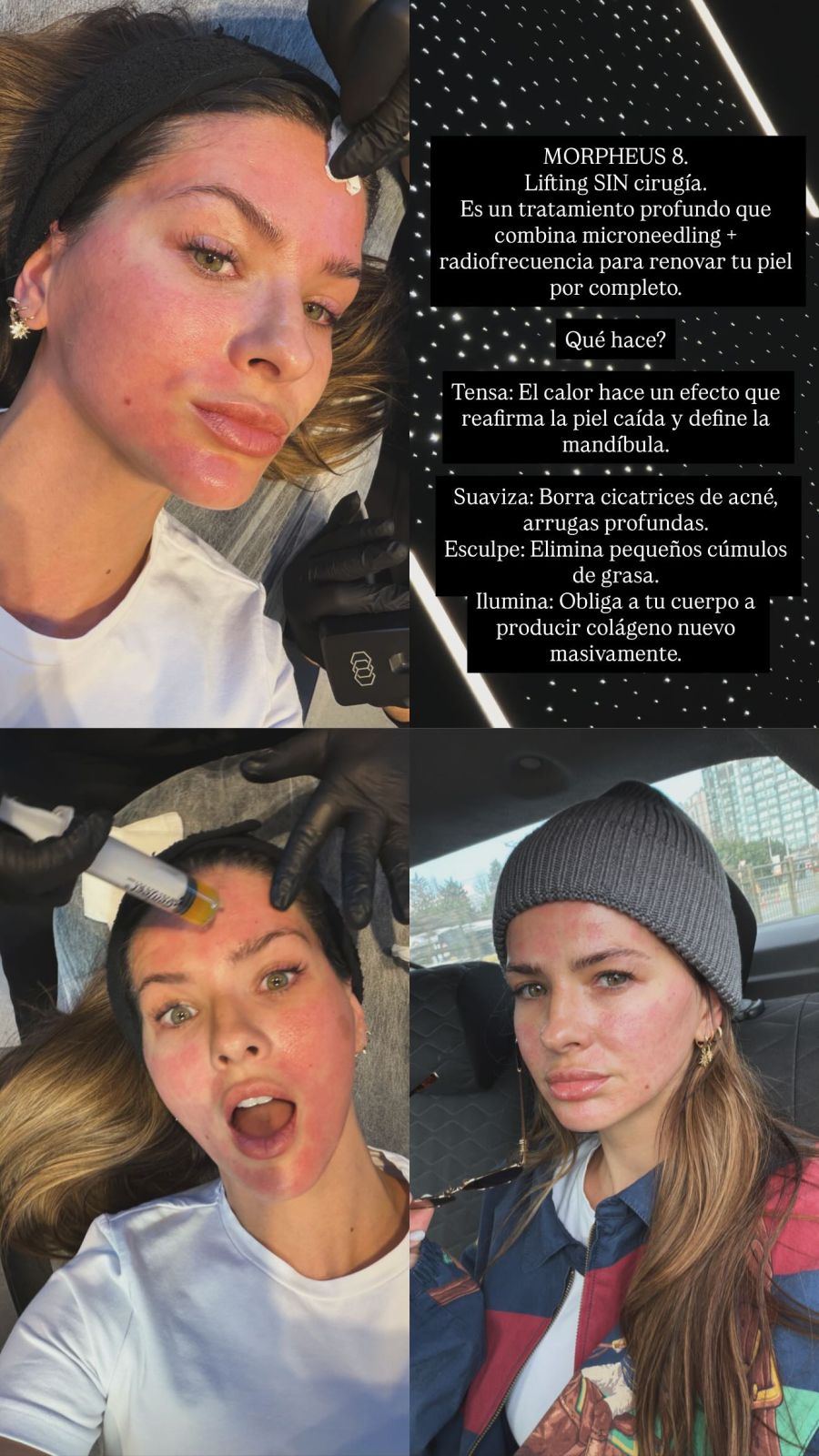 La China Suárez mostró la intervención que se hizo en su rostro