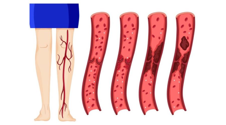 Trombosis: una condición frecuente que merece nuestra atención
