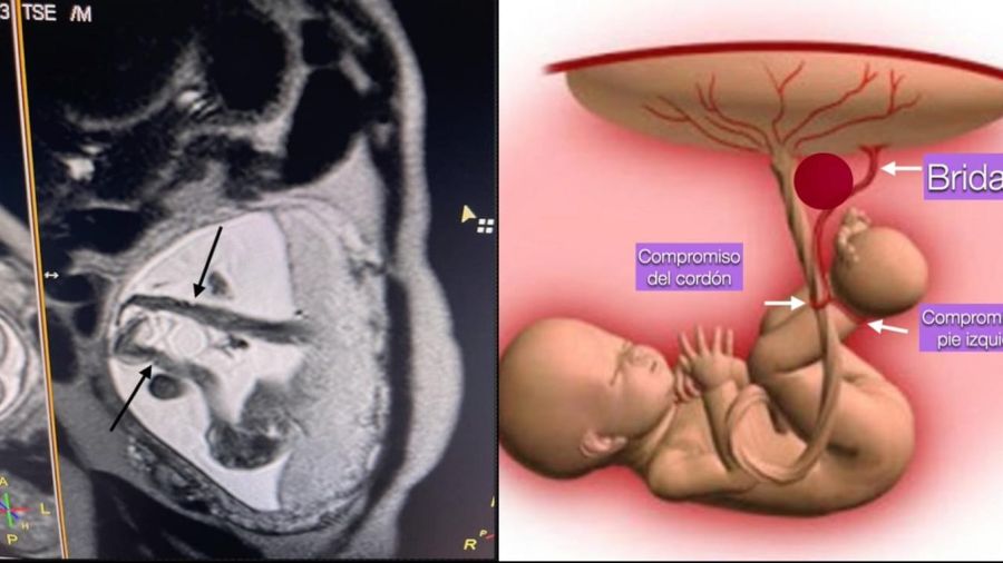 cirugia fetal intrauterina