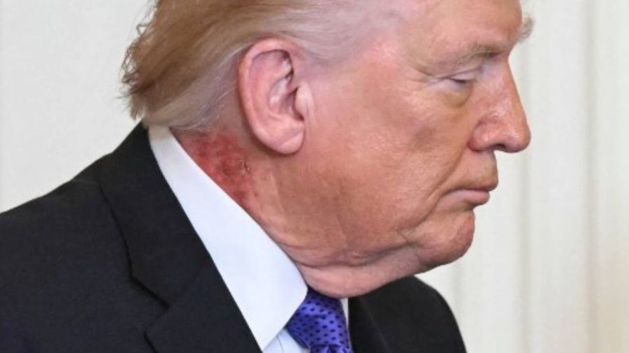Donald Trump y la mancha roja en el cuello 03032026
