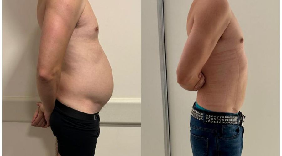 DIÁSTASIS EN HOMBRES: signos y síntomas