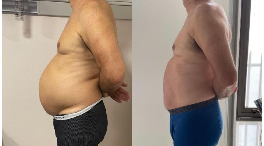 DIÁSTASIS EN HOMBRES: signos y síntomas