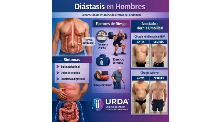 DIÁSTASIS EN HOMBRES: signos y síntomas