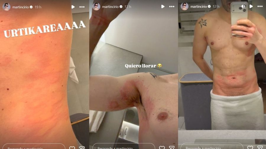 Martin Cirio urticaria