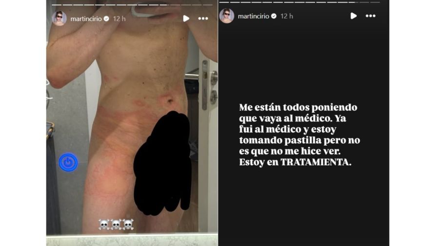 Martin Cirio urticaria