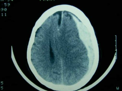 hematoma subdural