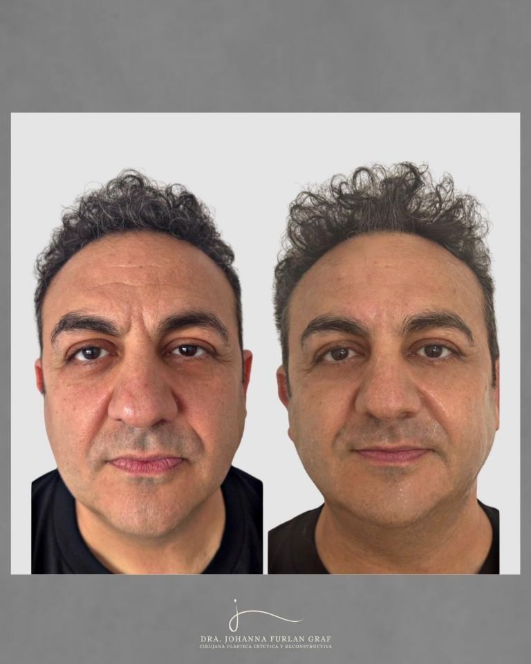 Antes y después de Topa