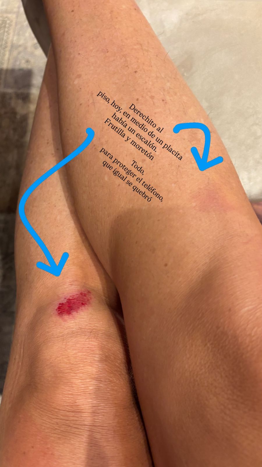 Florencia Raggi mostró las heridas tras tropezarse en una plaza