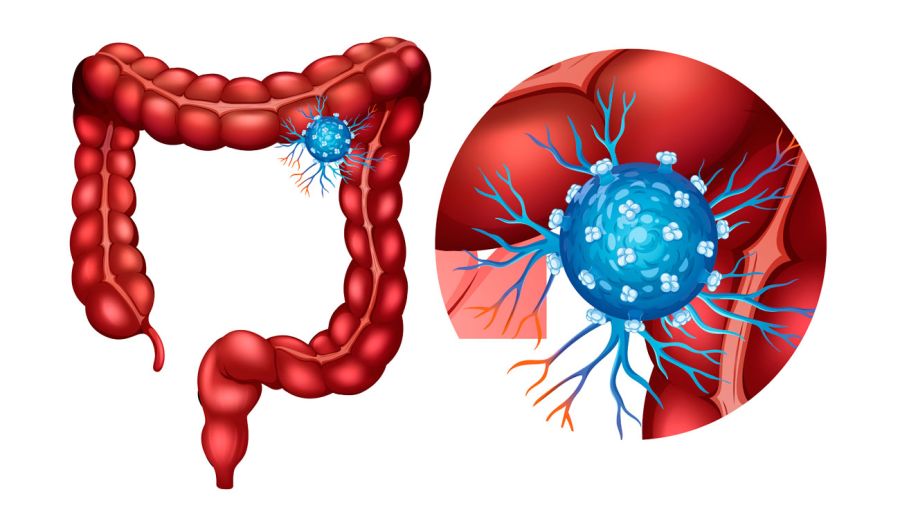 Cáncer de colon 06052026