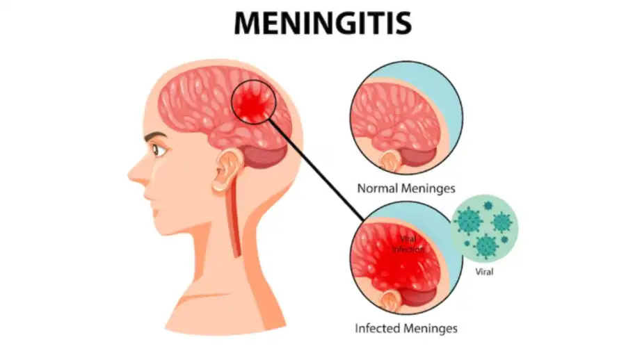 Aumentaron los casos de meningitis 12052026
