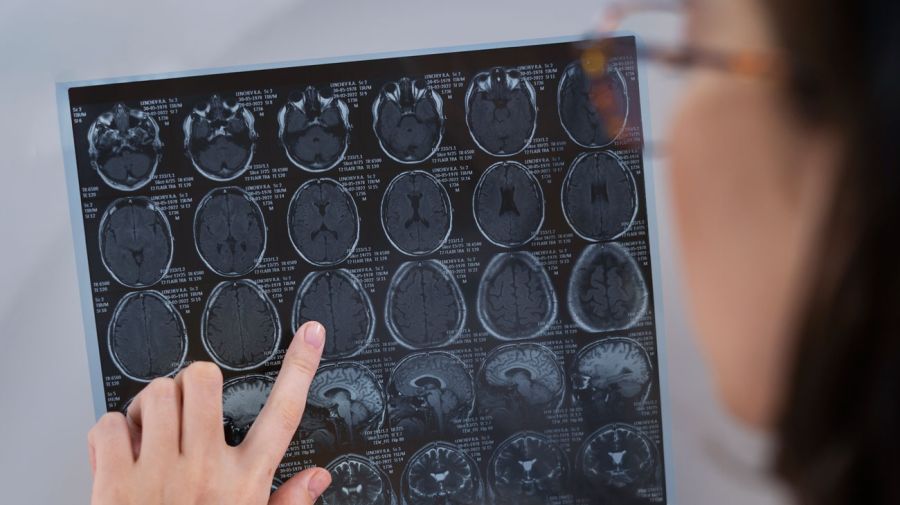 Cáncer cerebral 13052026