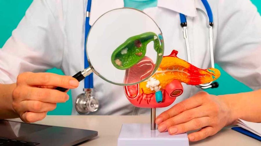 Cáncer de páncreas 03062026