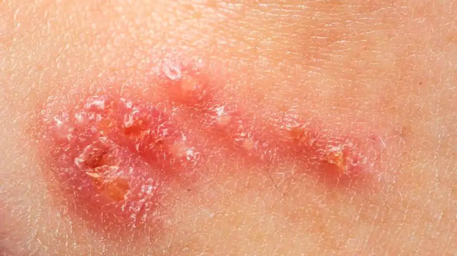 Herpes 16062026