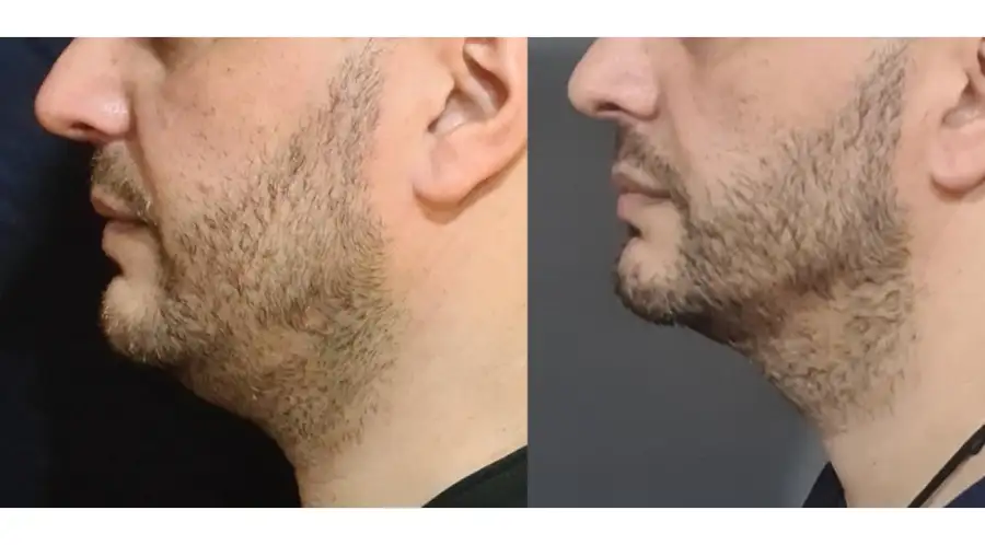 El éxito del rejuvenecimiento facial sin cirugía