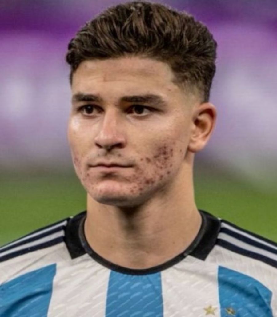 Tratamiento dermatológico de Julián Álvarez