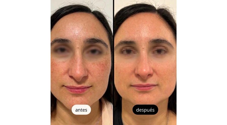 ¿Manchas en la cara? Todo lo que necesitas saber sobre Melasma