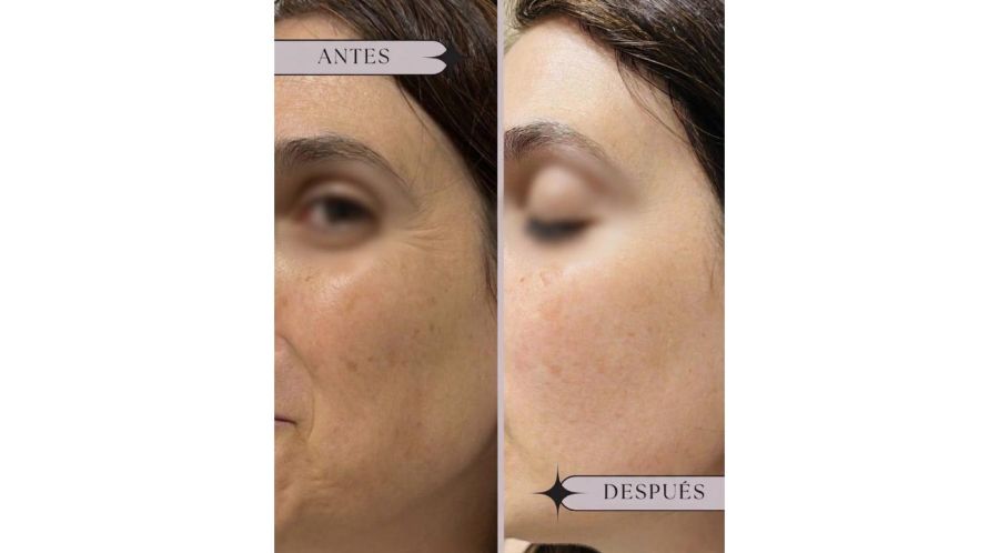 ¿Manchas en la cara? Todo lo que necesitas saber sobre Melasma