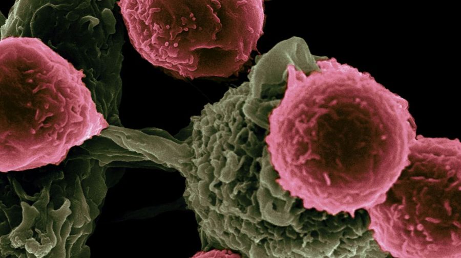 Ginecologia - Cancer
